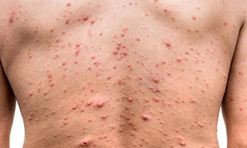 Santé : c’est quoi la Variole de singe dont des cas suspects ont été signalés en Guinée ?